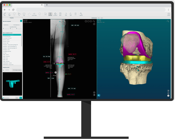 PeekMed | 3D planning system for orthopedic surgery